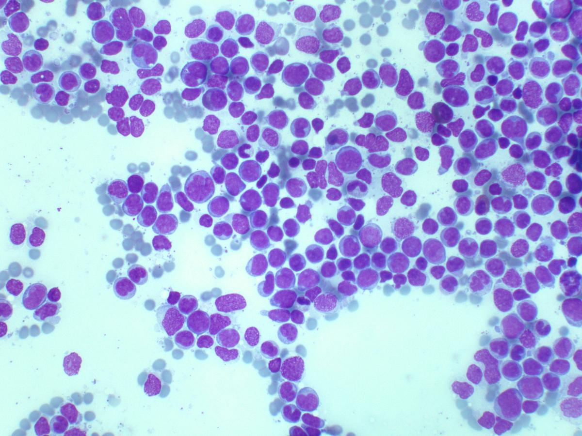 Aspirate Smear